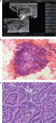 Comparison of S-Detect and thyroid imaging reporting and data system classifications in the diagnosis of cytologically indeterminate thyroid nodules